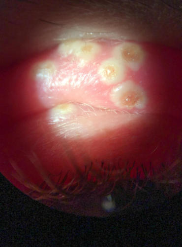 Herpes simplex - postižení kůže víčka